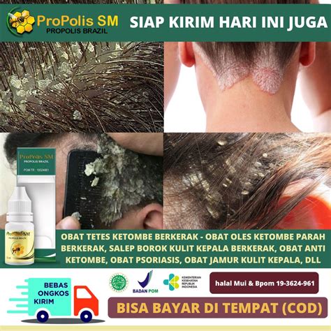 Jual Obat Penghilang Gatal Di Kulit Kepala Akibat Infeksi Jamur