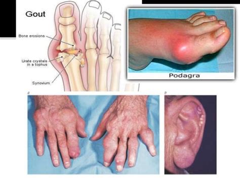 Gout And Pseudogout