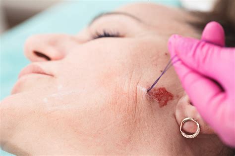 Dermabrasion After Mohs Surgery Improving Scar Appearance