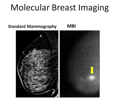 Mayo Clinic On Twitter Mbi Or Molecular Breast Imaging Uses A