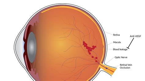 Revolutionizing Retinal Disease Treatment New Breakthroughs Offer Hope