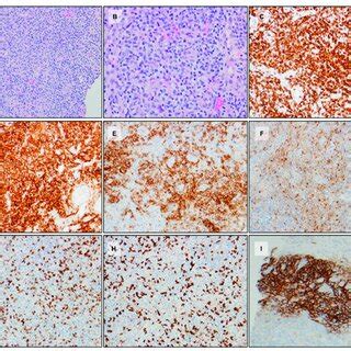 Follicular T-cell lymphoma with a PTGC-like pattern. (A) The lymph node ...