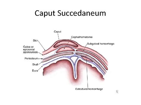 Birth Injuries Caput Succedaneum CAPUT SUCCEDANEUM Definition A