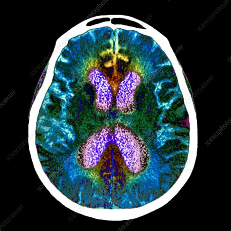 Alzheimers Disease Ct Scan Stock Image C0551958 Science Photo