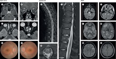 Diagnosis Of Myelin Oligodendrocyte Glycoprotein Antibody Associated