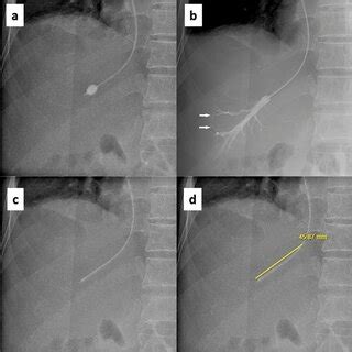 impact  catheter tip  hepatic vein ostium distance