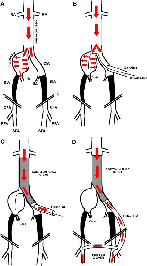 Hybrid Open Endovascular Repair Of Para Anastomotic Common Iliac Artery