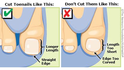 PSA: Don't cut your toenails too short, and always cut straight across ...