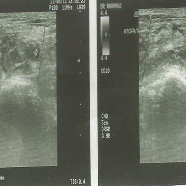 Deep vein Doppler ultrasound of left lower extremity showed that common... | Download Scientific ...