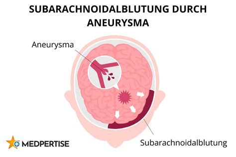 Subarachnoidalblutung Ursachen Symptome Behandlung