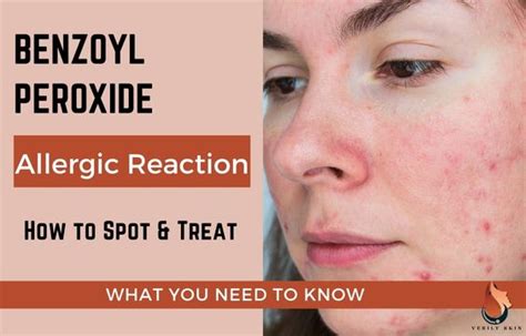 Benzoyl Peroxide Allergy: How To Spot & Treat - Sasily Skin