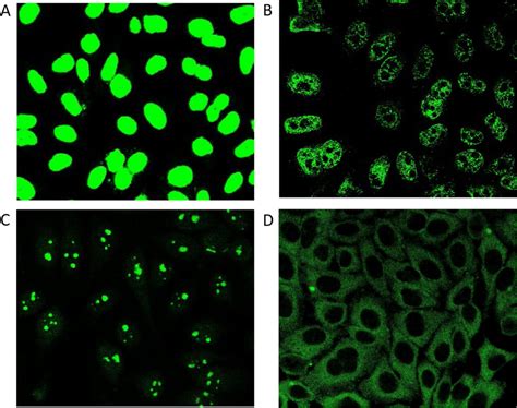 Examples Of Diverse Salivary Ana Patterns In 47 Saliva Ana Positive Sle