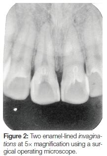 Dens In Dente Lateral Incisor