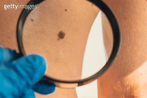 Mole Dermoscopy Preventive Of Melanoma Dermatologist Examining