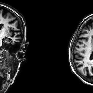 Brain MRI of patient 2, showing diffuse atrophy, more evident on... | Download Scientific Diagram