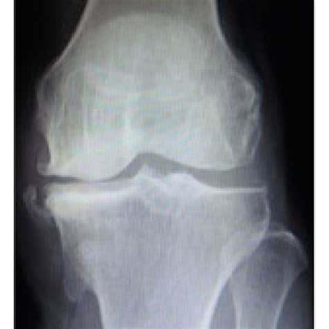 Acceleration Of The Conventional And Bicruciate Stabilized Total Knee