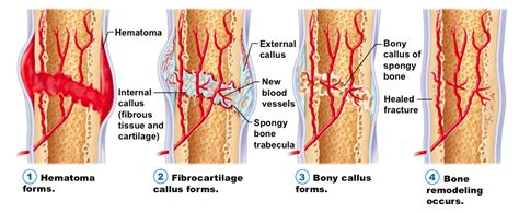 Fracture Repair Ms Gallagher S Classroom