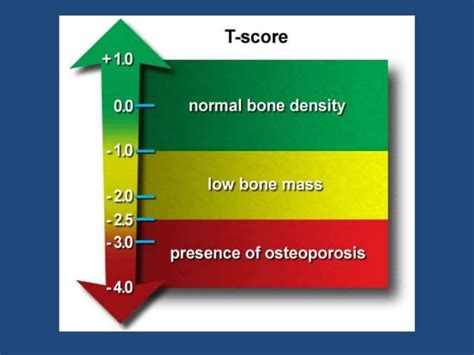 Bone Mineral Density Bmd Test Ppt