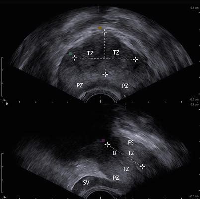 Prostate Zones Ultrasound