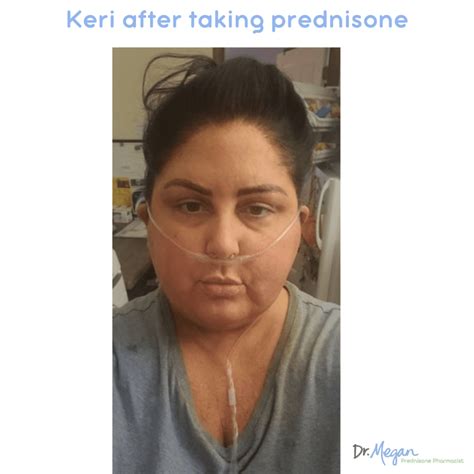 Prednisone Moon Face