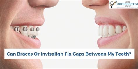 Can Braces Or Invisalign Fix Gaps Between My Teeth Miami