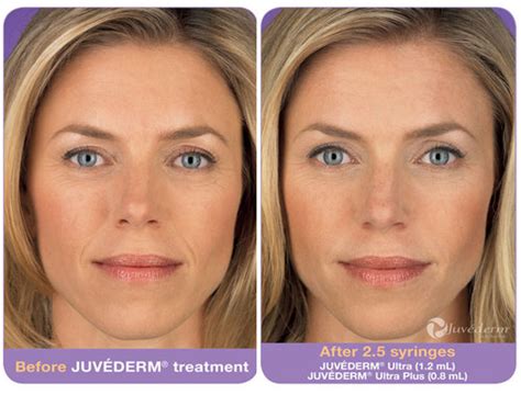 Juvederm Lip Injections In Tampa The Cost Of Juvederm Treatment