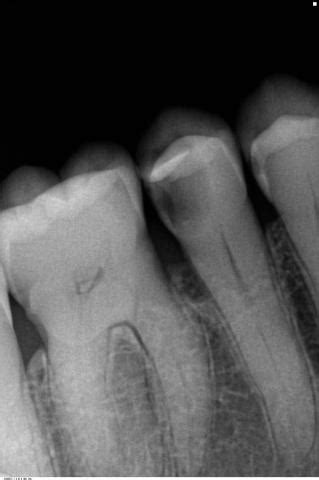 C T Pro Overlay C Ramique Biodentine La D Fense Dentiste