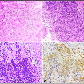 A. FS from GEJ growth reported as negative for Malignancy in Frozen... | Download Scientific Diagram