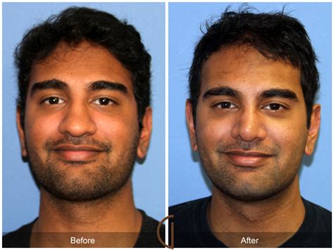 Rhinoplasty Before And After Male