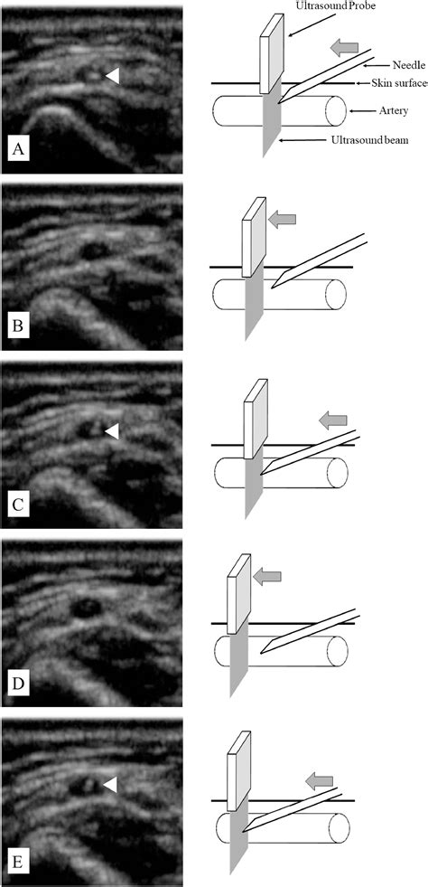 Dynamic Needle Tip Positioning For Ultrasound Guided Arterial