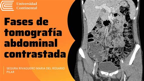 Fases De Tomograf A Abdominal Contrastada Maria Segura Udocz