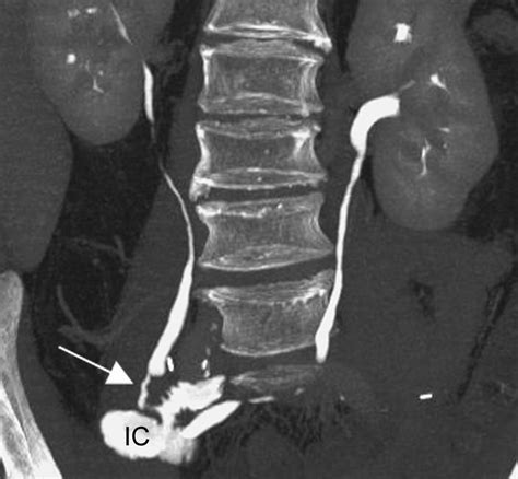 Ileal Conduit Radiology