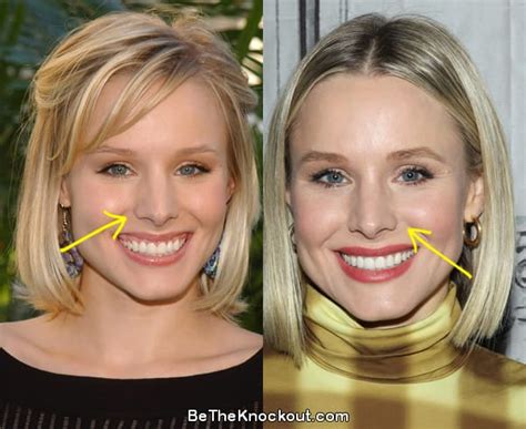 Kristen Bell Plastic Surgery Comparison Photos