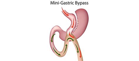 Mini gastric bypass - Safe Health Doctors