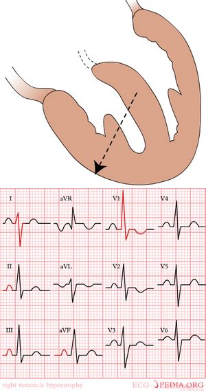 Right Ventricular Hypertrophy WikEM