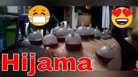 Wet Cupping Therapy Hijama For Skin Care My First Hijama Cupping