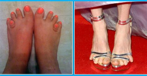 Top 19 des plus moches photos de pieds De quoi décomplexer