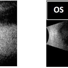 (PDF) Optic Disc Drusen, Important Detail in the Differential Diagnosis of Optic Disc Edema