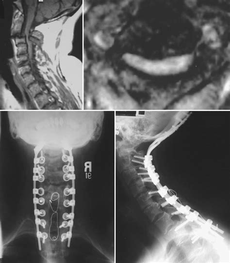 complications Archive - Neurosurgery Blog