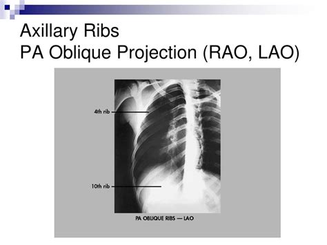 Ppt Bony Thorax Powerpoint Presentation Free Download Id7087072