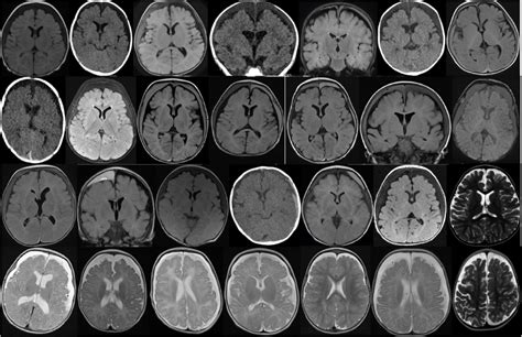 Ct Or Mri Images Approximately At The Level Of The Foramina Of Monro Download Scientific