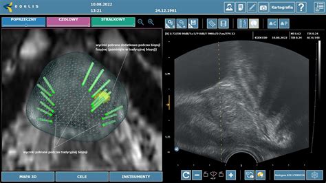 Biopsja fuzyjna prostaty dr n med Krzysztof Ossoliński specjalista