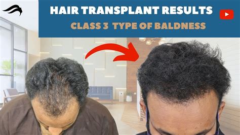 Hair Transplant In Mysore Best Surgeon Results And Cost Of Hair