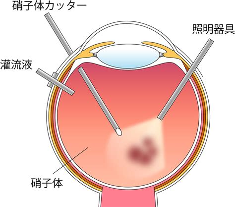 眼内レンズ強膜内固定術茨城県水戸市の小沢眼科内科病院