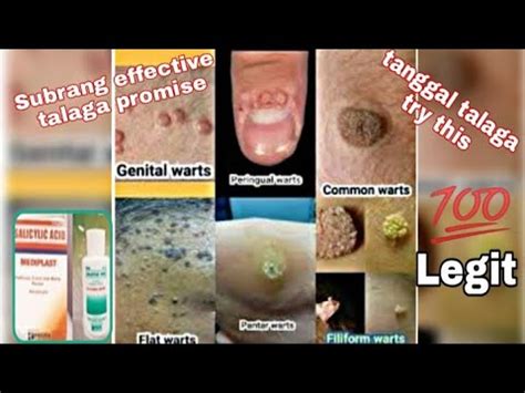 PAANO MATANGGAL ANG KULUGO SA BALAT I SALICYLIC ACID GAMOT PARA SA MGA