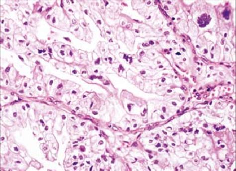 Renal Mass Showing Infiltrative Nests And Sheets Of Neoplastic Cells