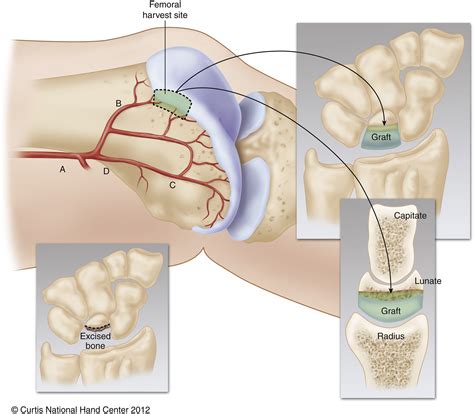 Vascularized Medial Femoral Trochlea Osteochondral Flap Reconstruction