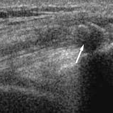 (PDF) A pictorial overview of ultrasound of tendon disorders