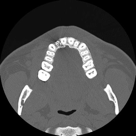 Normal Sinus Ct Annotated Radiopaedia Axial Bone Window