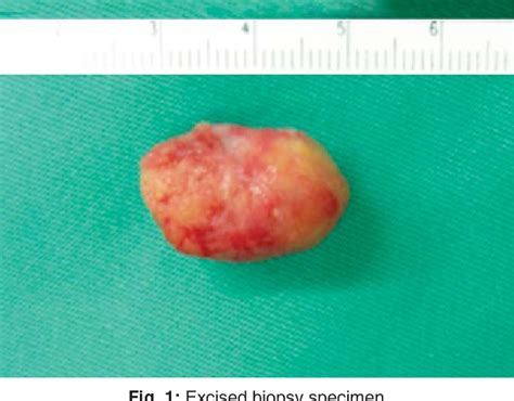 Figure From Myoepithelial Carcinoma Of The Soft Palate Semantic Scholar